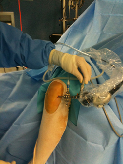 Chirurgie et prothese du genou - Opération et arthroscopie
