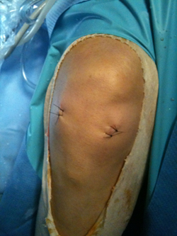 Chirurgie et prothese du genou - Opération et arthroscopie